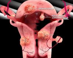 Uterine Fibroid Embolization Cost in India | IR Facilities 