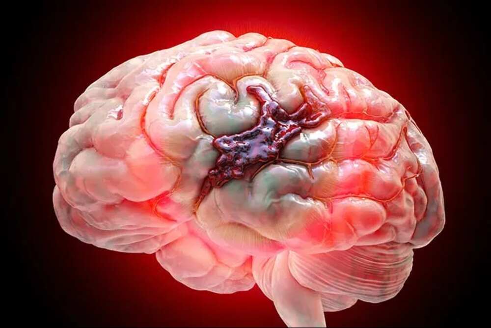 Affordable Brain Hemorrhage Treatment Cost in India