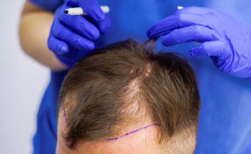 تكلفة زراعة الشعر في دبي وأبو ظبي والشارقة والعين
