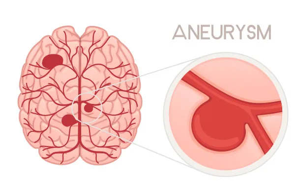 Aneurysm Endovascular Coiling | Advanced Minimally Invasive Treatment